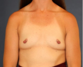 Feel Beautiful - Breast Augmentation 150 - Before Photo
